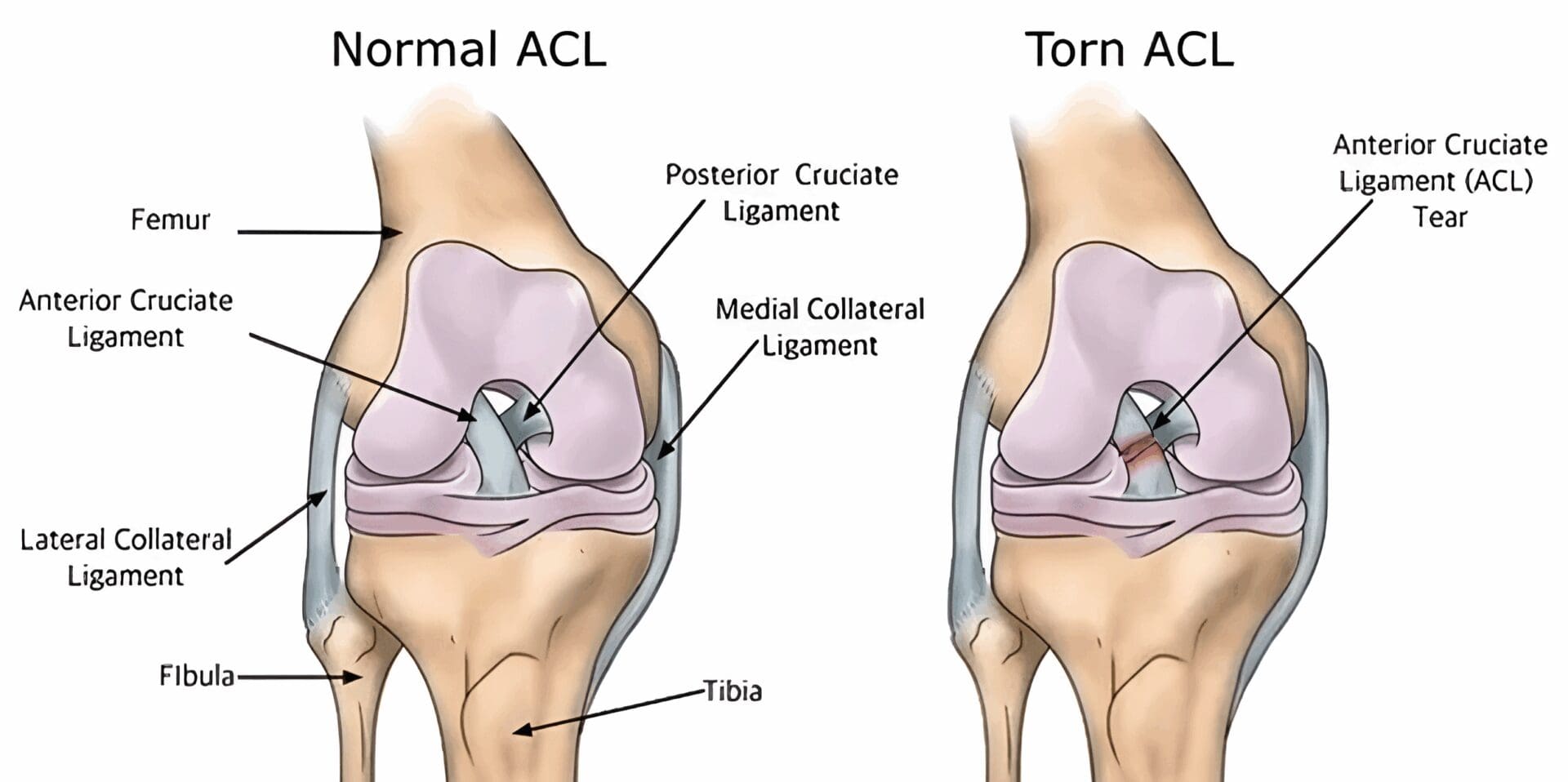 Normal and torn ACL knee illustration.