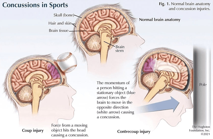 Brain concussion injuries diagram in sports.