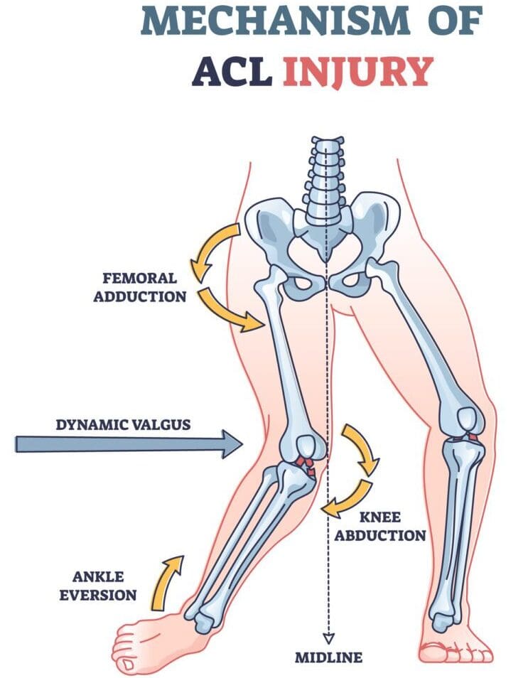 Diagram of ACL injury mechanism.