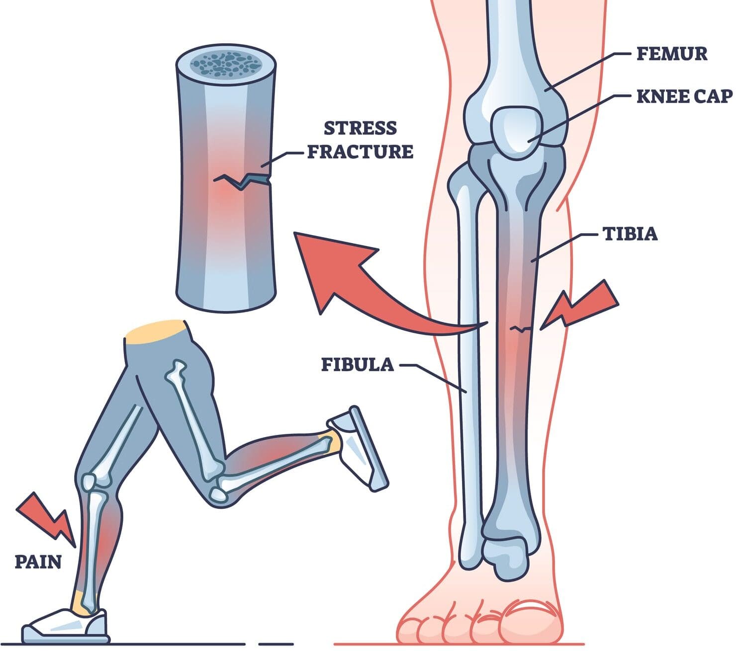 Leg stress fracture diagram with labeled bones.
