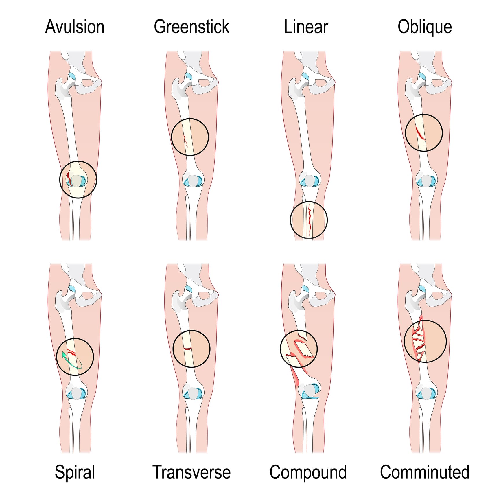 Diagram of different types of bone fractures.