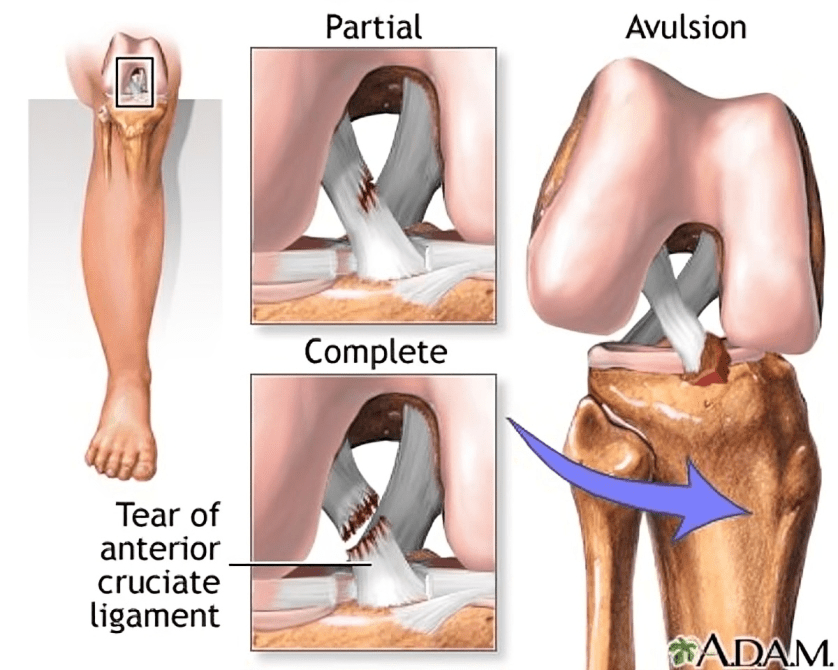 Anterior cruciate ligament tear illustration.